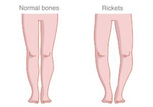 Bowed Legs