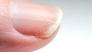 Thin and Brittle Nails