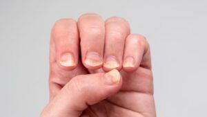 Thin and Brittle Nails